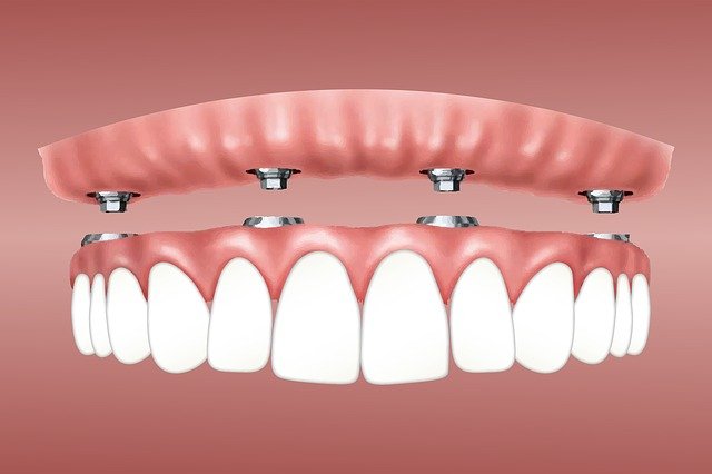 visi dantys ant 4 implantu pro arch