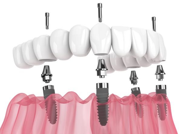 visi dantys ant 4 implantu