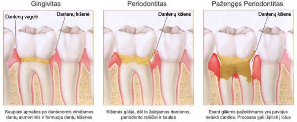 Periodontitas parodontoze