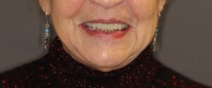Visi dantys ant 4 implantų_po proceduros