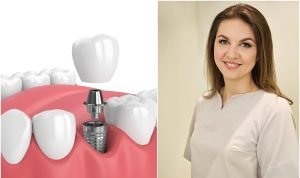 dantų implantai_vieno danties praradimas