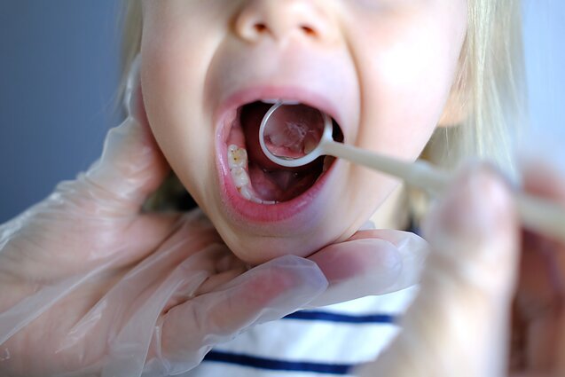Vaikų odontologės kasdienybė: išpuvę pieniniai dantys ir gydymas bendroje nejautroje